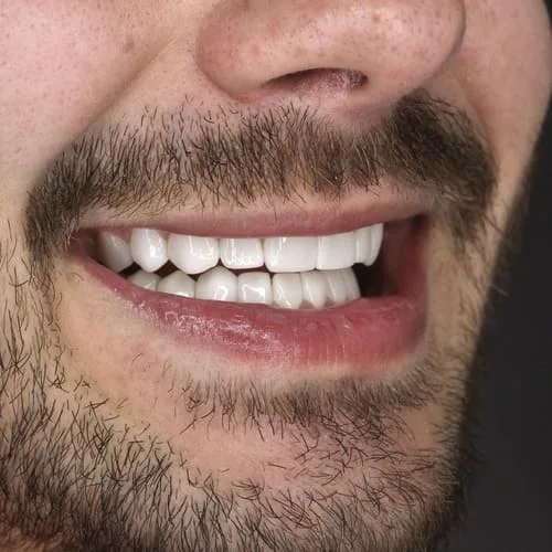 Resultado de estética dental