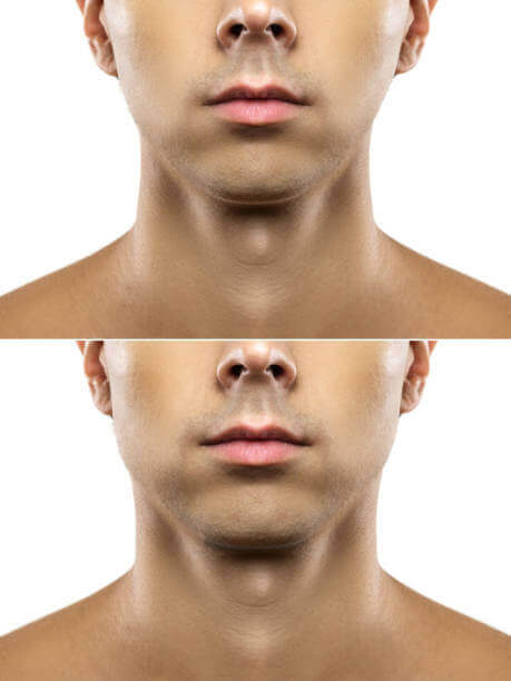 Marcación mandibular con ácido hialurónico en hombres