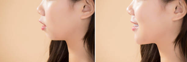 antes y después marcación mandibular 